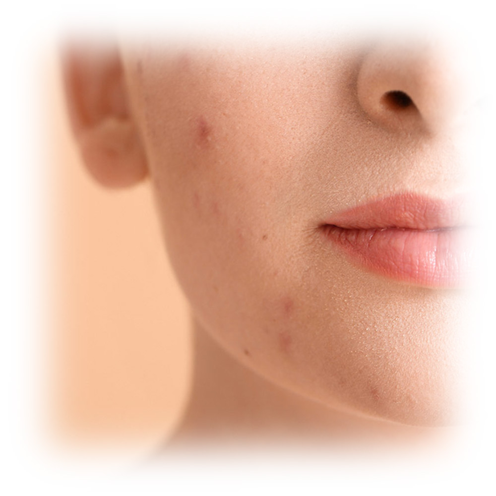 acne-treatments-03