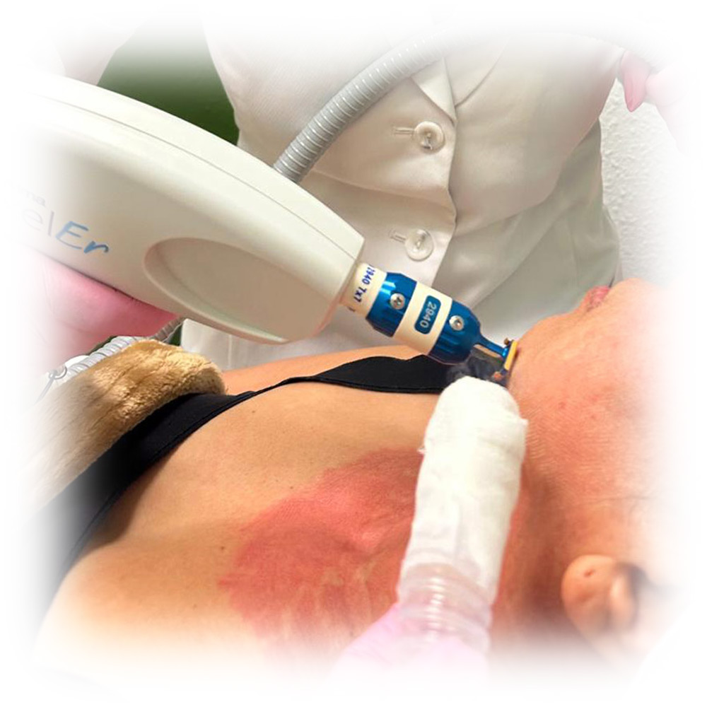 strecht-marks-treatments-04