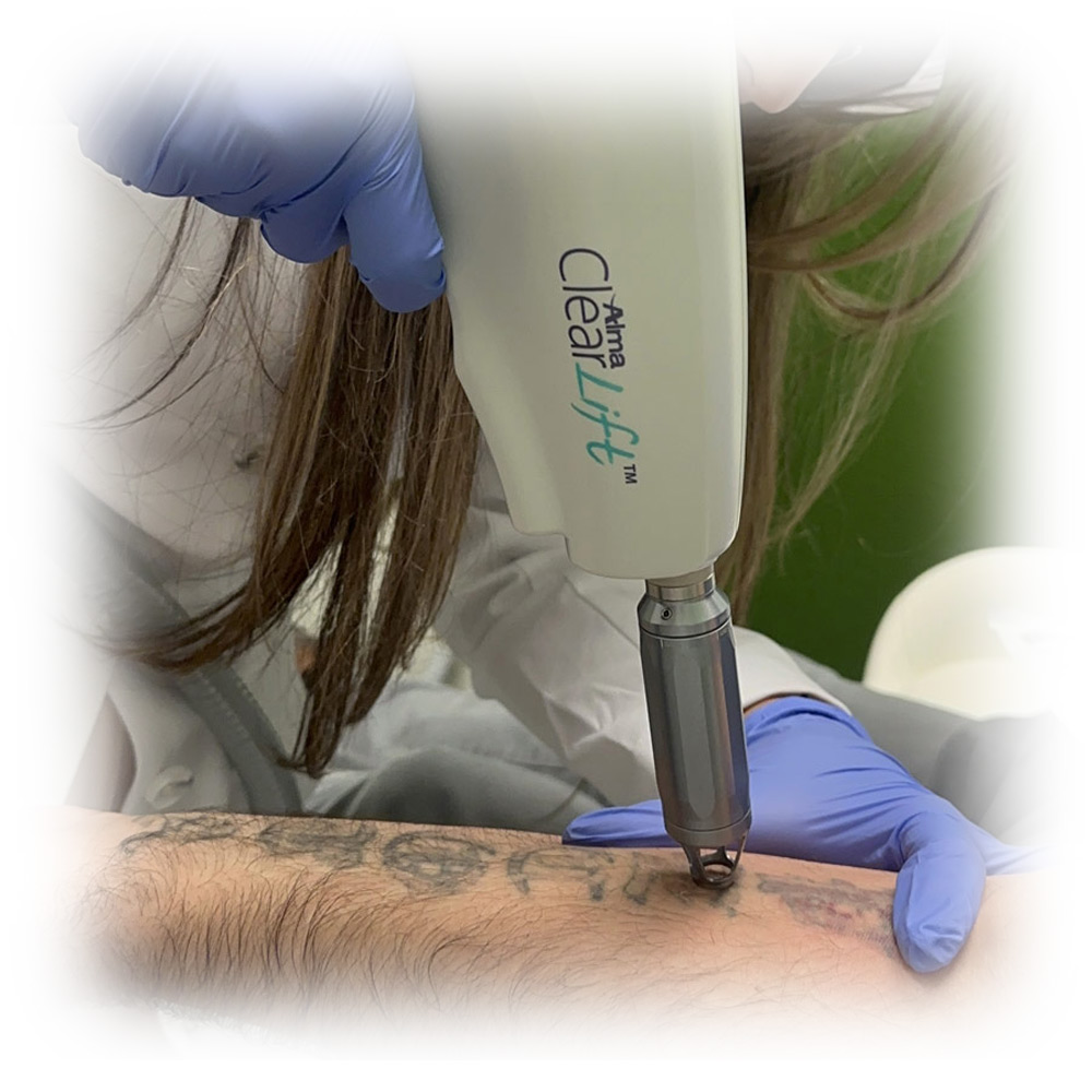 tattoo-removal-treatments-05